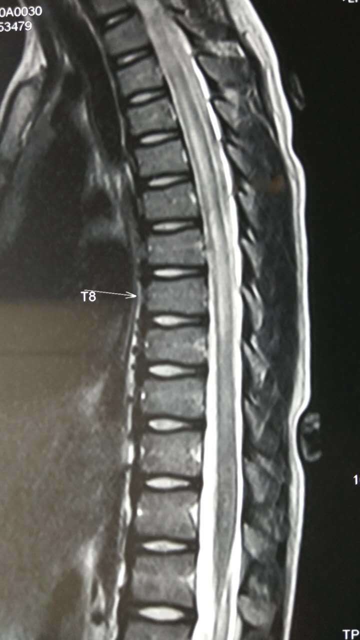 脊髓炎核磁共振图片