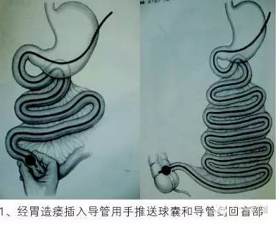 经肛型肠梗阻导管图片