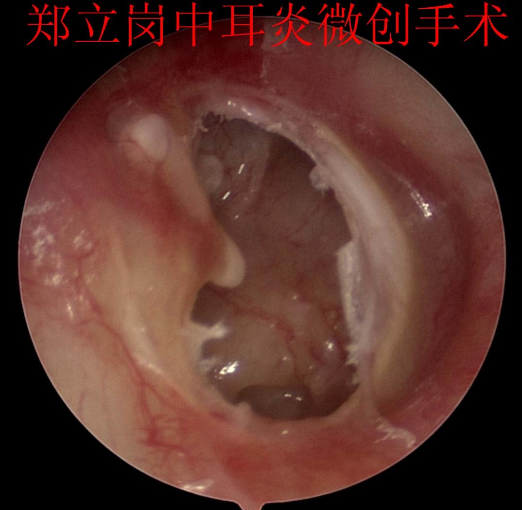 前言:中耳炎微創手術是目前治療慢性化膿性中耳炎及膽脂瘤型中耳炎最