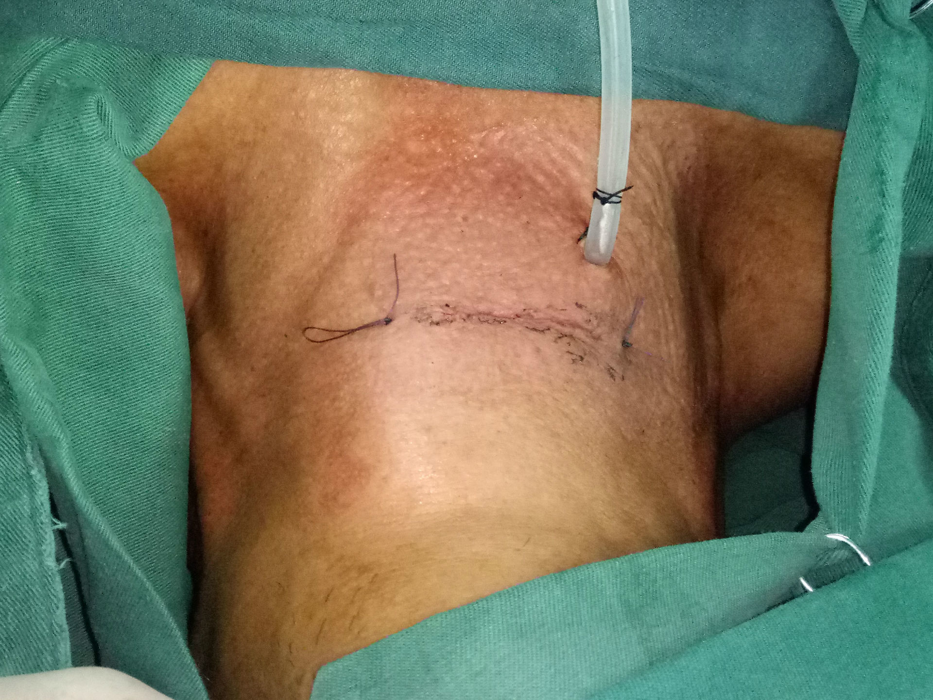 我院首例颈椎前路减压零切记椎间融合器植骨内固定手术 - 好大夫在线