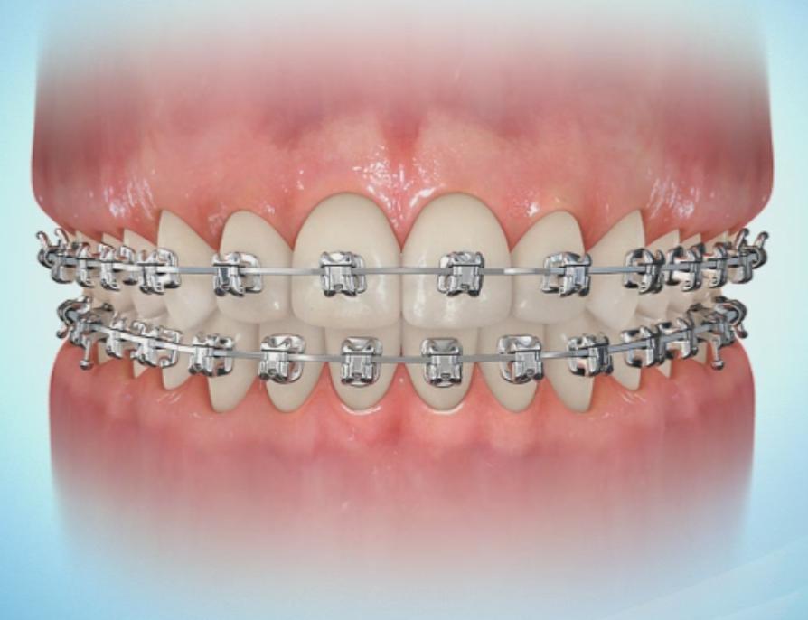 牙齿矫正的基本流程
