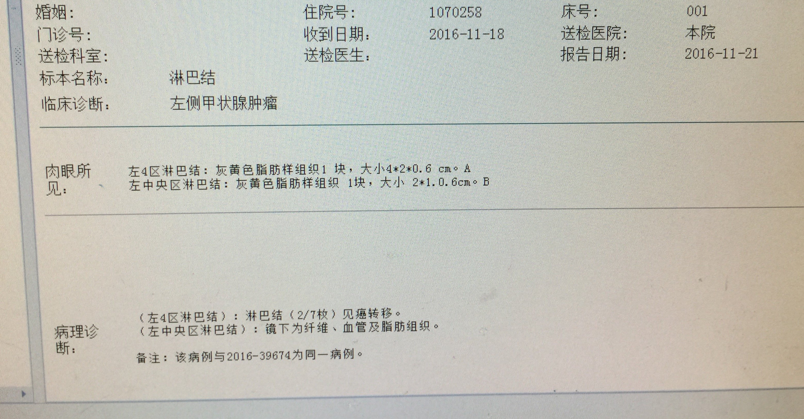 甲状腺乳头状微癌跳跃性侧区转移 - 好大夫在线