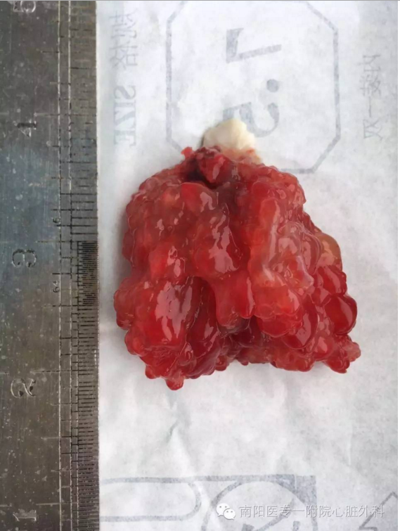 粘液乳头状型室管膜瘤图片
