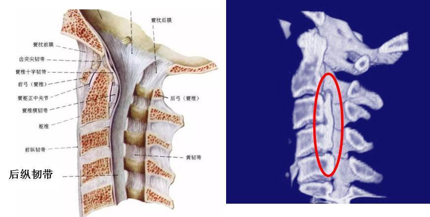 颈椎后纵韧带骨化症opll常见问题解答