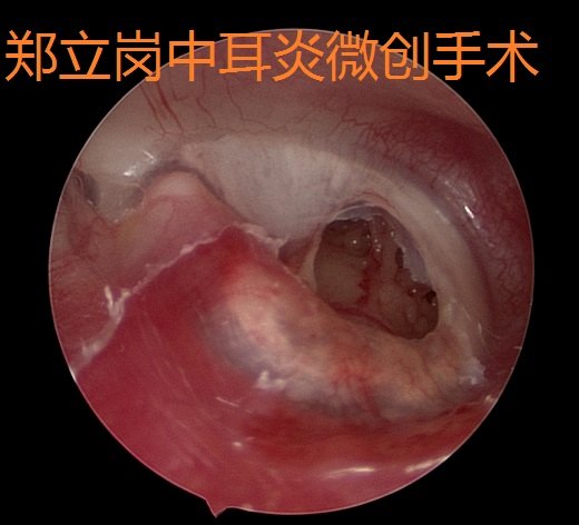 前言:中耳炎微創手術是目前治療慢性化膿性中耳炎及膽脂瘤型中耳炎最