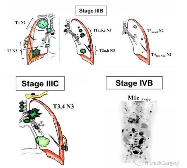肺癌第八版图片