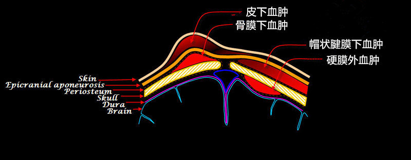 按血肿出现于头皮内的具体层次可分为皮下血肿,帽状键膜下血肿和骨膜