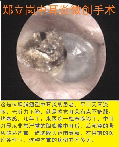 前言:中耳炎微創手術是目前治療慢性化膿性中耳炎及膽脂瘤型中耳炎最