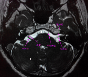 三叉神经mri影像解剖图图片