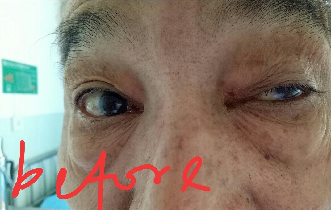 针灸治疗动眼神经麻痹——病例