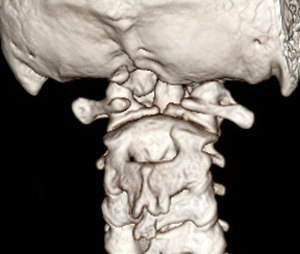 这是患者来我院时做的颈椎三维ct检查,发现患者的寰椎后弓已经