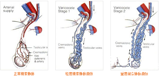精索静脉曲张诊断和术前评估标准 - 好大夫在线