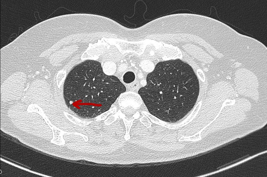 关于肺部小结节,磨玻璃样病变问题的解答--真实病例分析篇