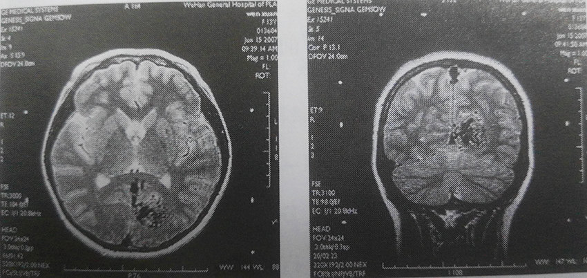 头部伽马刀治疗脑血管畸形病例分享(1)