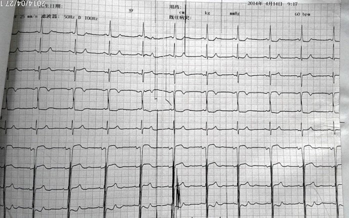 图二:发作时心电图,心脏停搏6.9s.