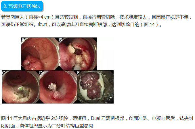 图文详解:结肠息肉切除术