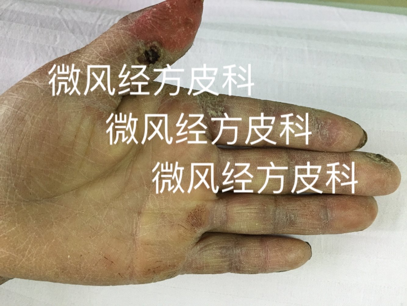 另类冻疮系统性红斑狼疮