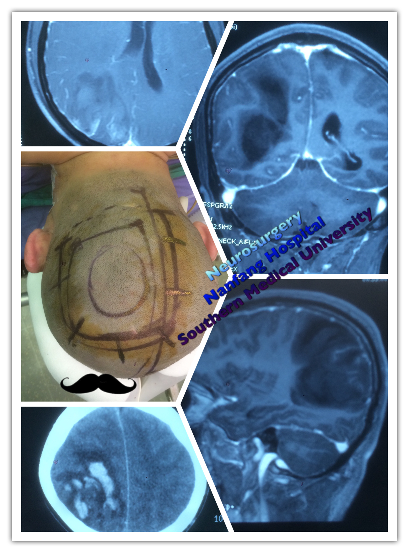 右侧顶枕叶自发脑出血病变切除 - 好大夫在线