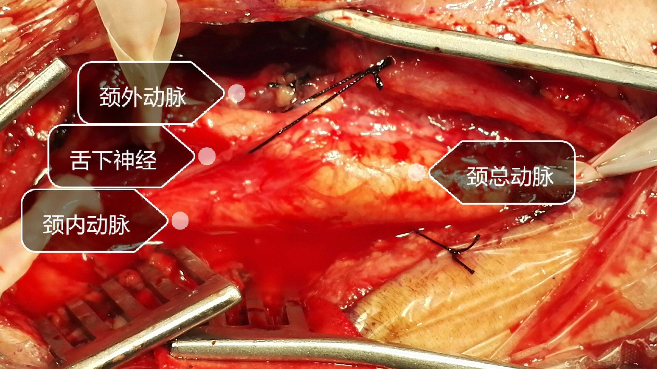 頸動脈狹窄腦中風患者的達摩克利斯之劍