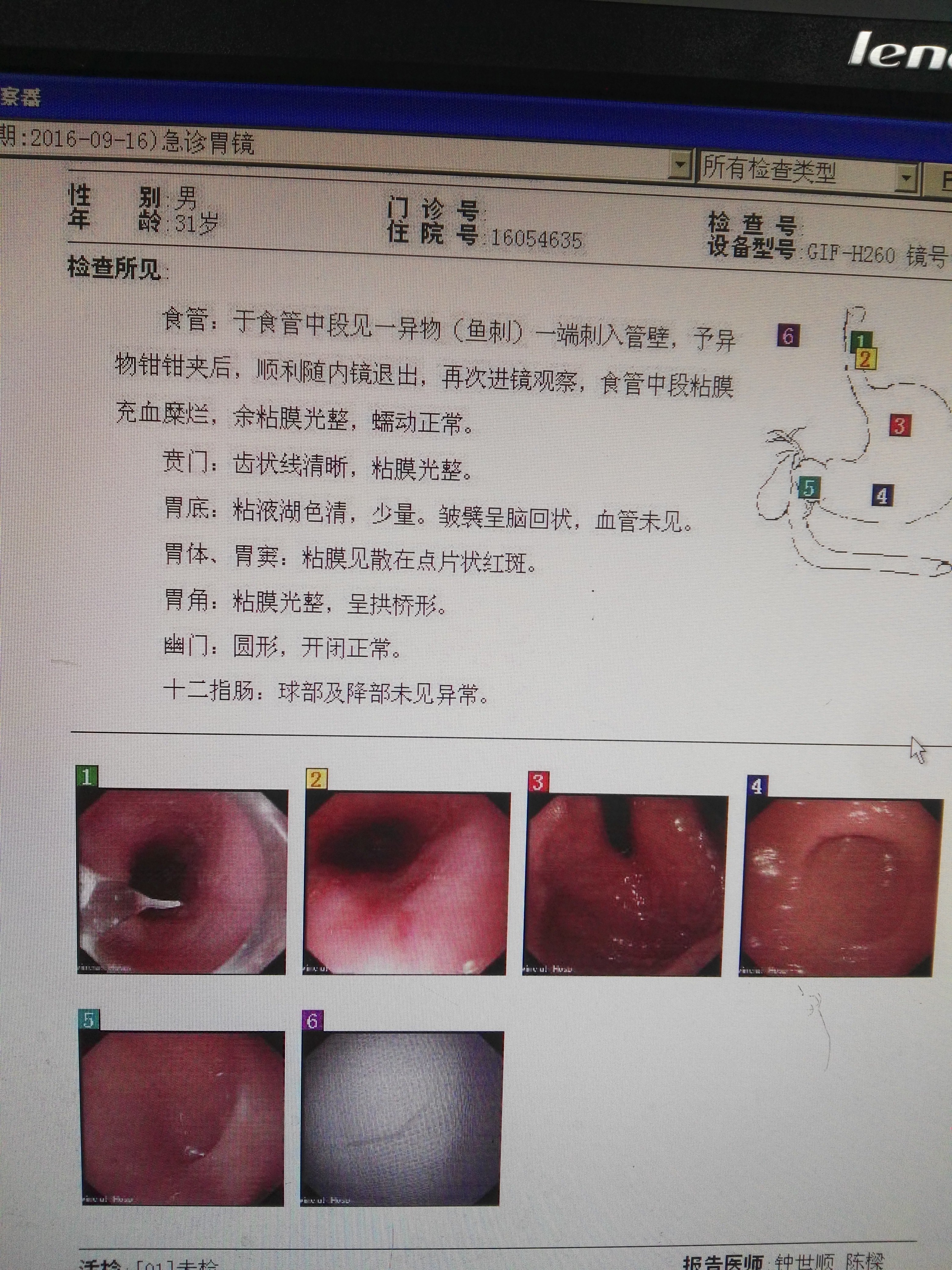 鱼刺,排骨,鳖甲-也谈食管异物的诊断治疗