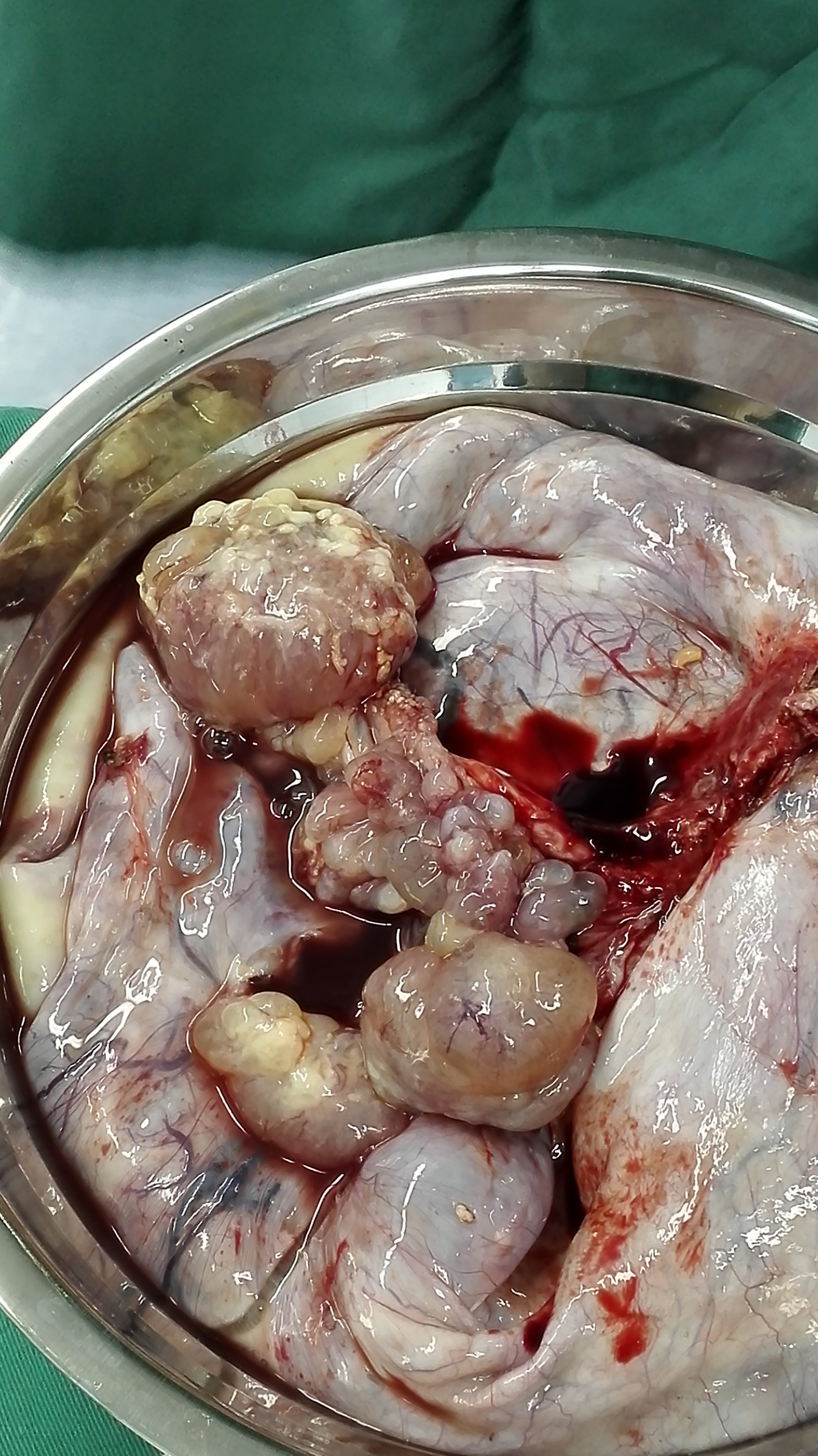 今天手术,老太太的病理是卵巢透明细胞癌 - 好大夫在线