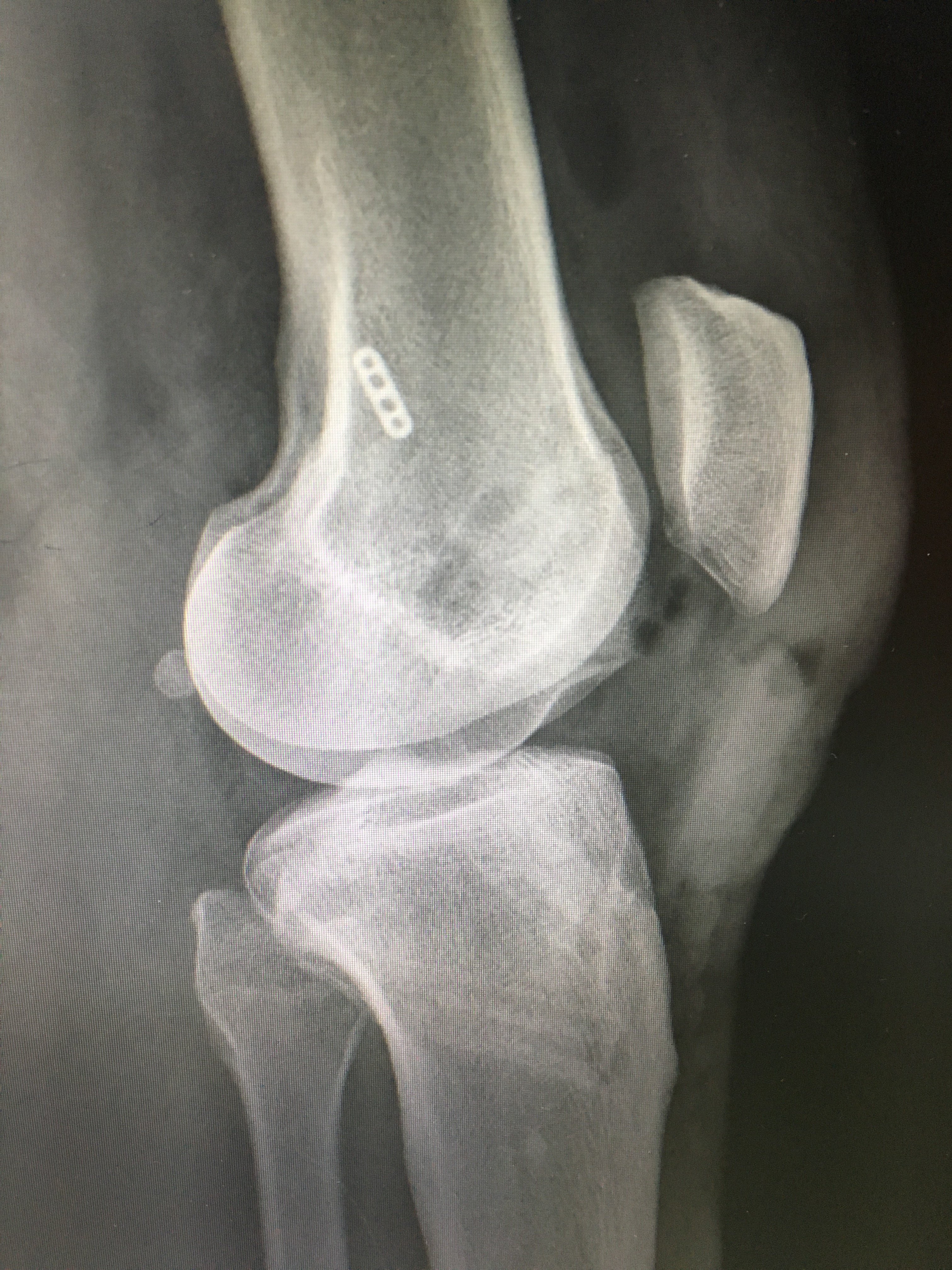 膝关节前后叉韧带损伤修复 