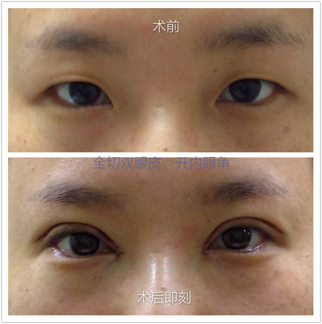 哪里有专业修复双眼皮的医院_双眼皮修复价格_双眼皮开眼角半年回缩了修复