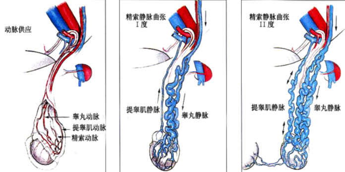 精索静脉曲张诊治新观念显微镜下除病患