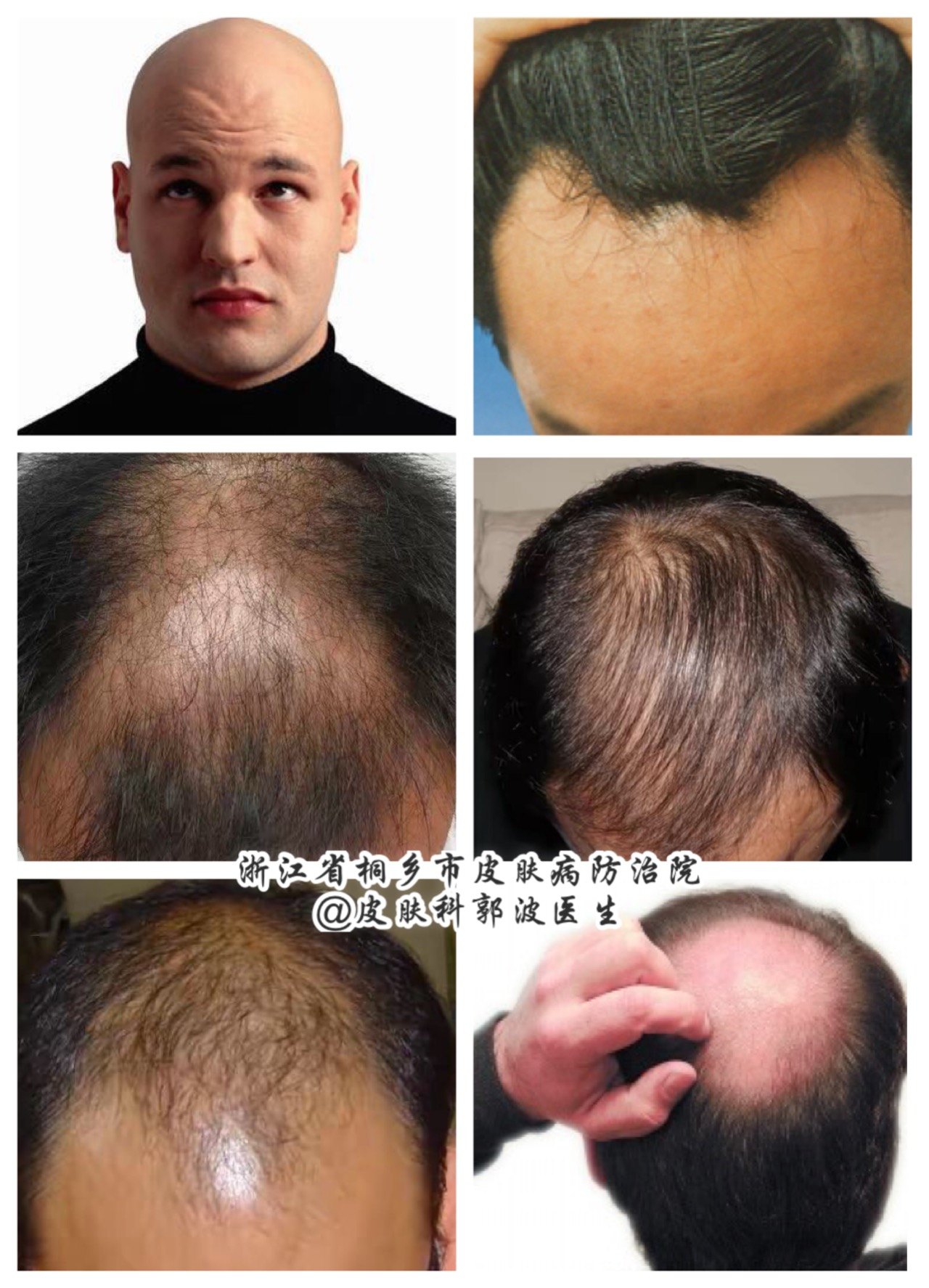 据统计,有25%的男性在30岁以前就出现了雄激素型脱发(也称脂溢性脱发)