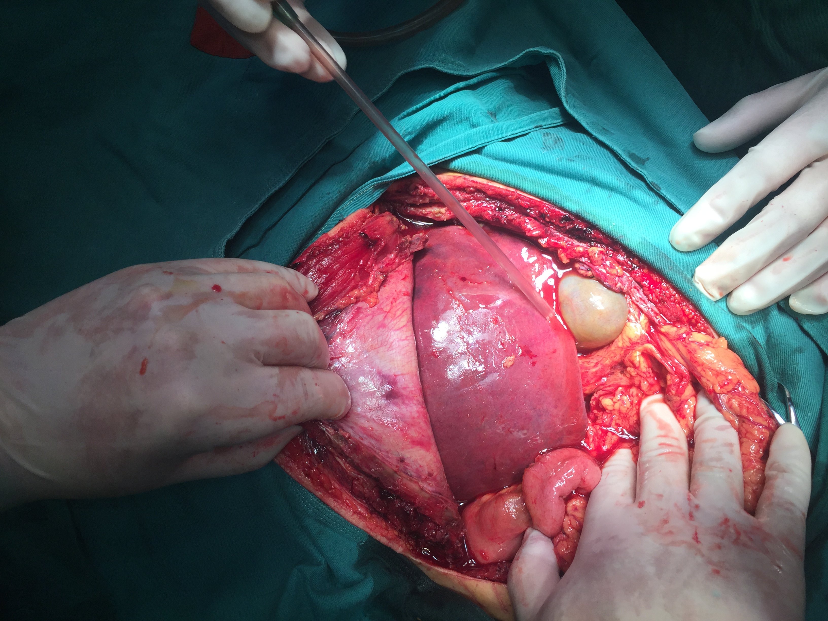 输血1万多毫升的肝静脉撕裂性肝破裂 - 好大夫在线