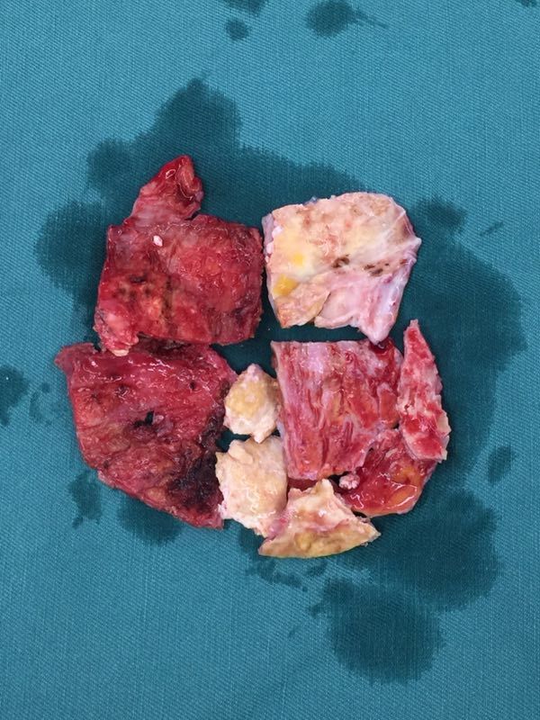 心脏被"乌龟壳"束缚住了--慢性缩窄性心包炎典型图片 - 好大夫在线