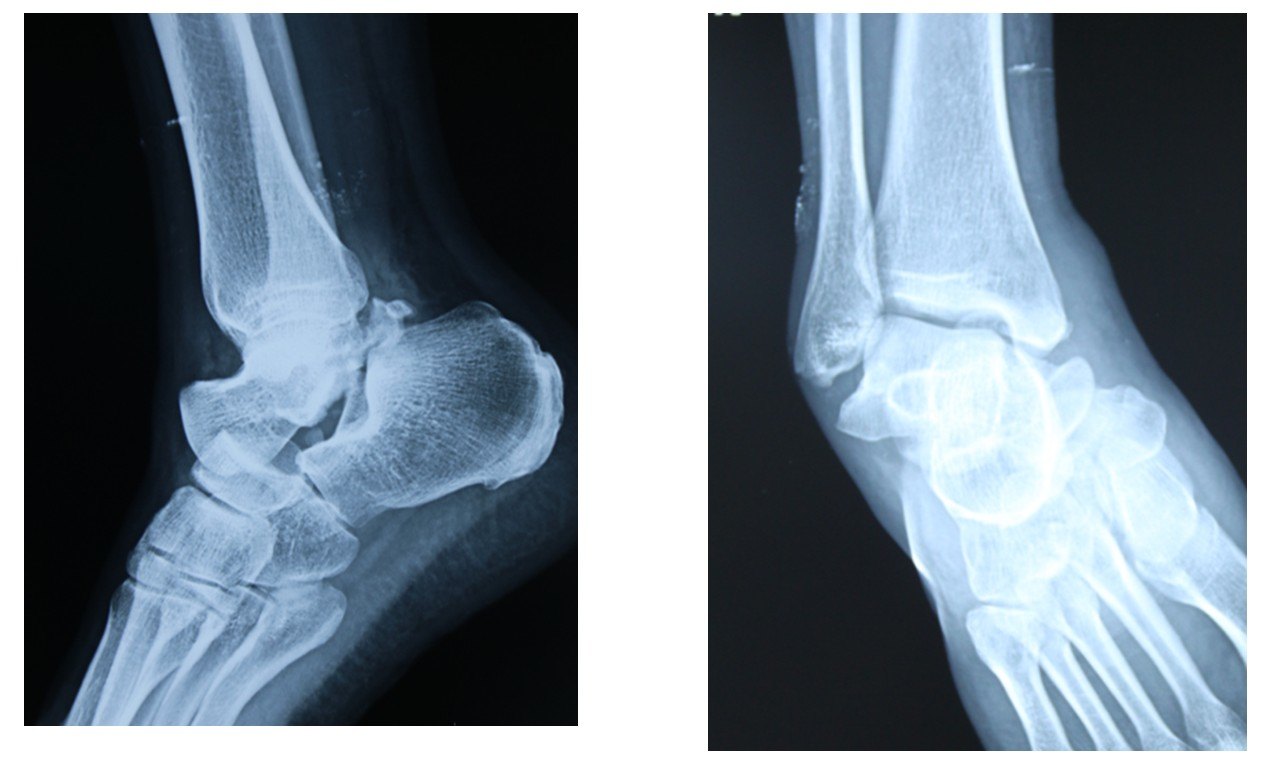 距骨骨折的踝关节镜下复位内固定治疗(病例2) 