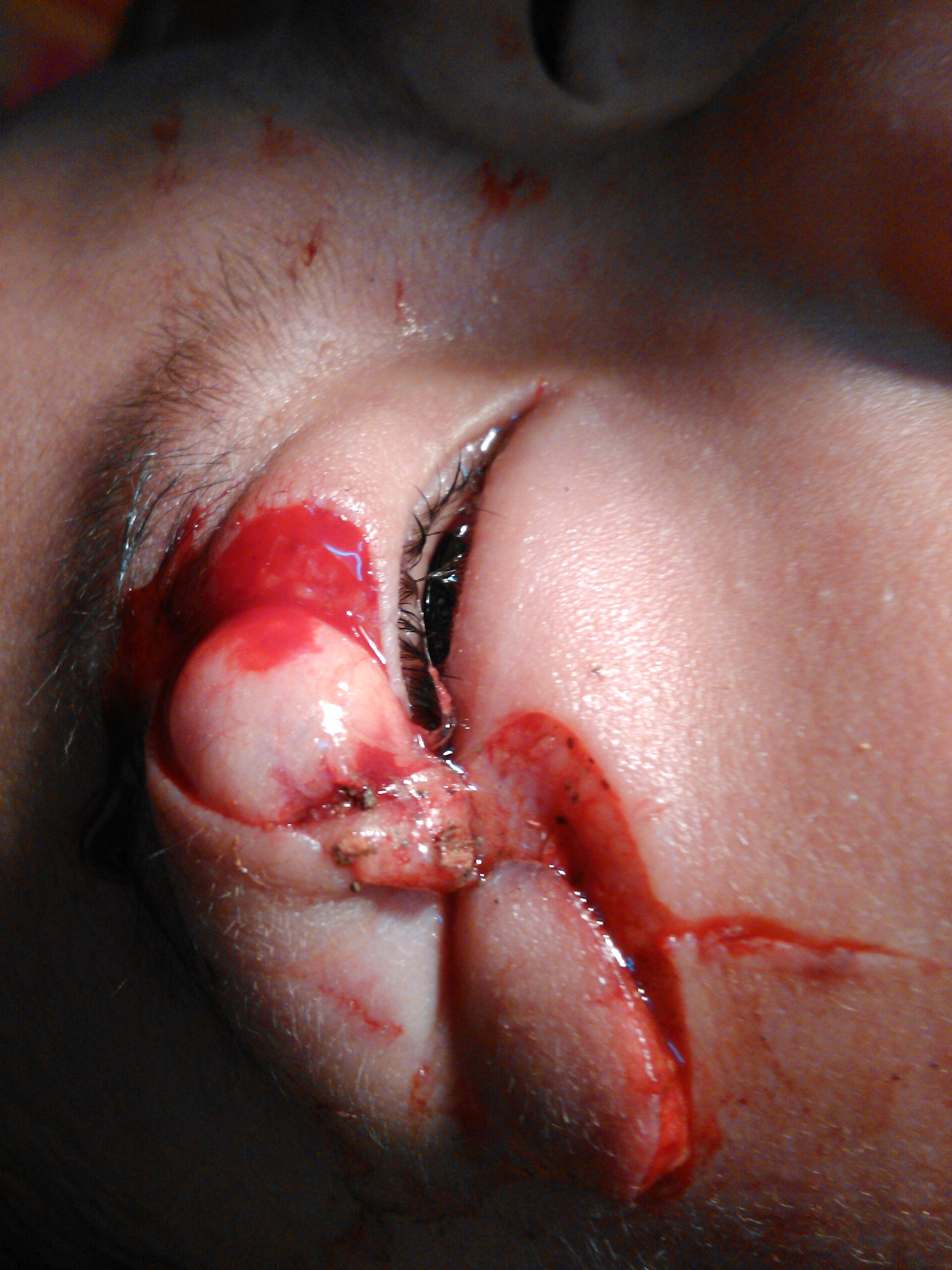 一例5岁宝宝的不规则眼睑裂伤美容缝合