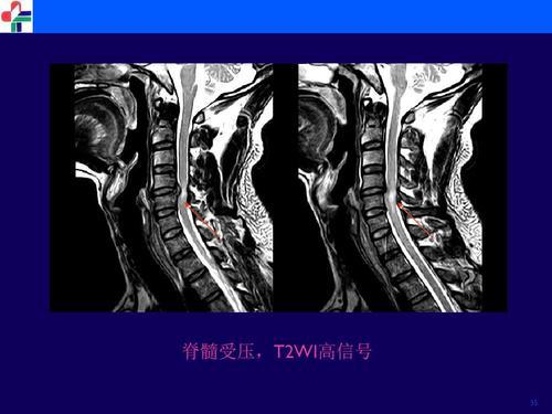 常见脊柱疾病的自检自查脊髓型颈椎病