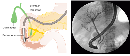 什么是ercp Est Enbd 胆道支架术 有哪些常见并发症 胆结石 好大夫在线 什么是ercp Est Enbd 胆道支架术 有哪些常见并发症 胆结石 好大夫在线