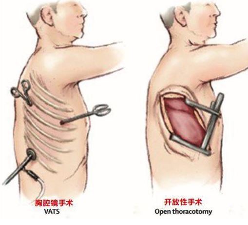 肺结节手术示意图图片