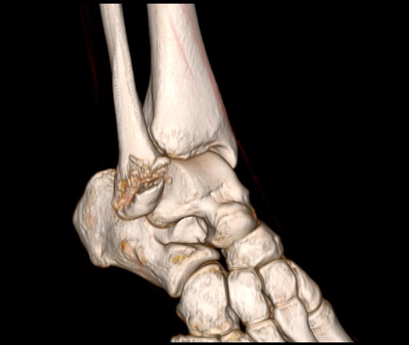 腓骨骨折需要手术吗 胫腓骨骨折 好大夫在线 腓骨骨折需要手术吗 胫腓骨骨折 好大夫在线