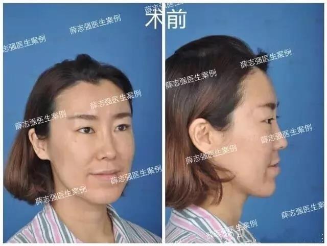 拿什么拯救你的大饼脸和月亮脸 鼻基底 鼻部整形