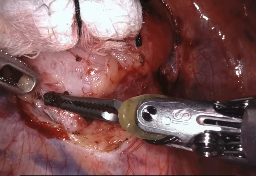 分离壁层胸膜,显露肿瘤