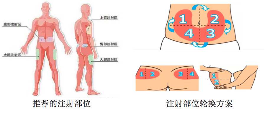 将注射部位分为四个等分区域(大腿或臀部可等分为两个等分区域),每周