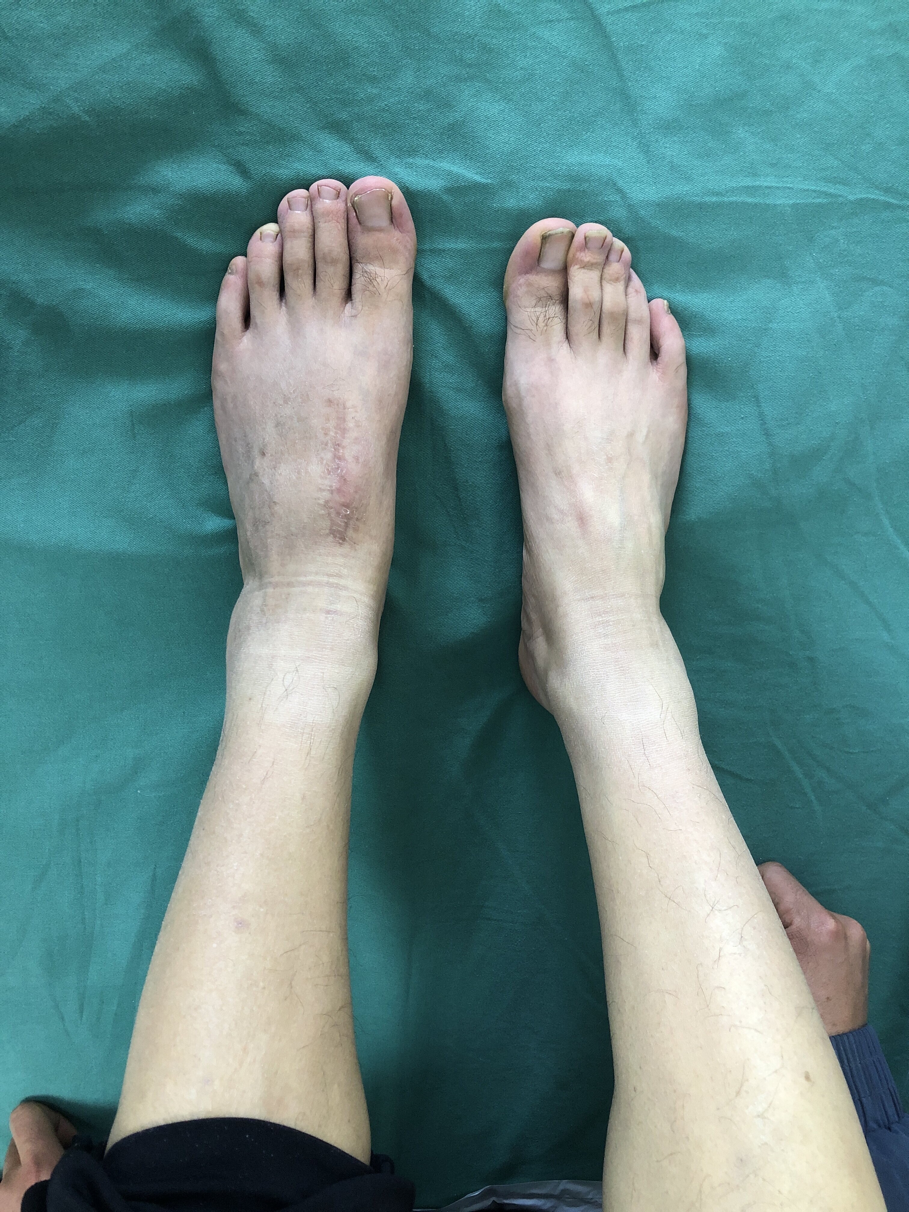 lisfranc损伤处理