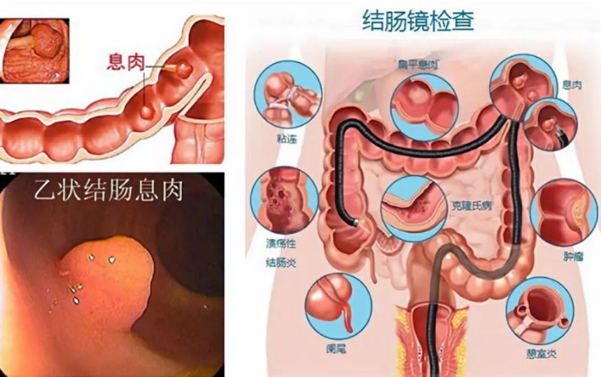 胃肠镜检查过程示意图图片