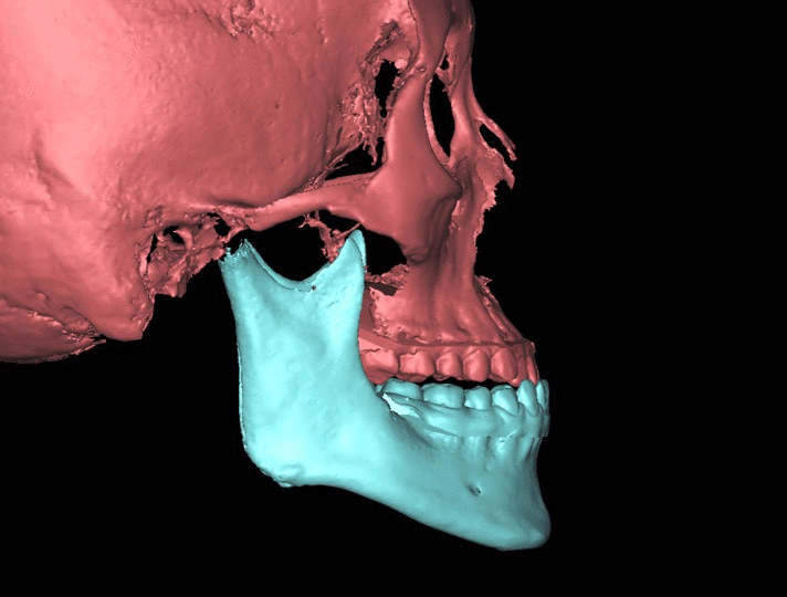 骨性iii类牙颌面畸形(地包天)的正畸正颌联合治疗