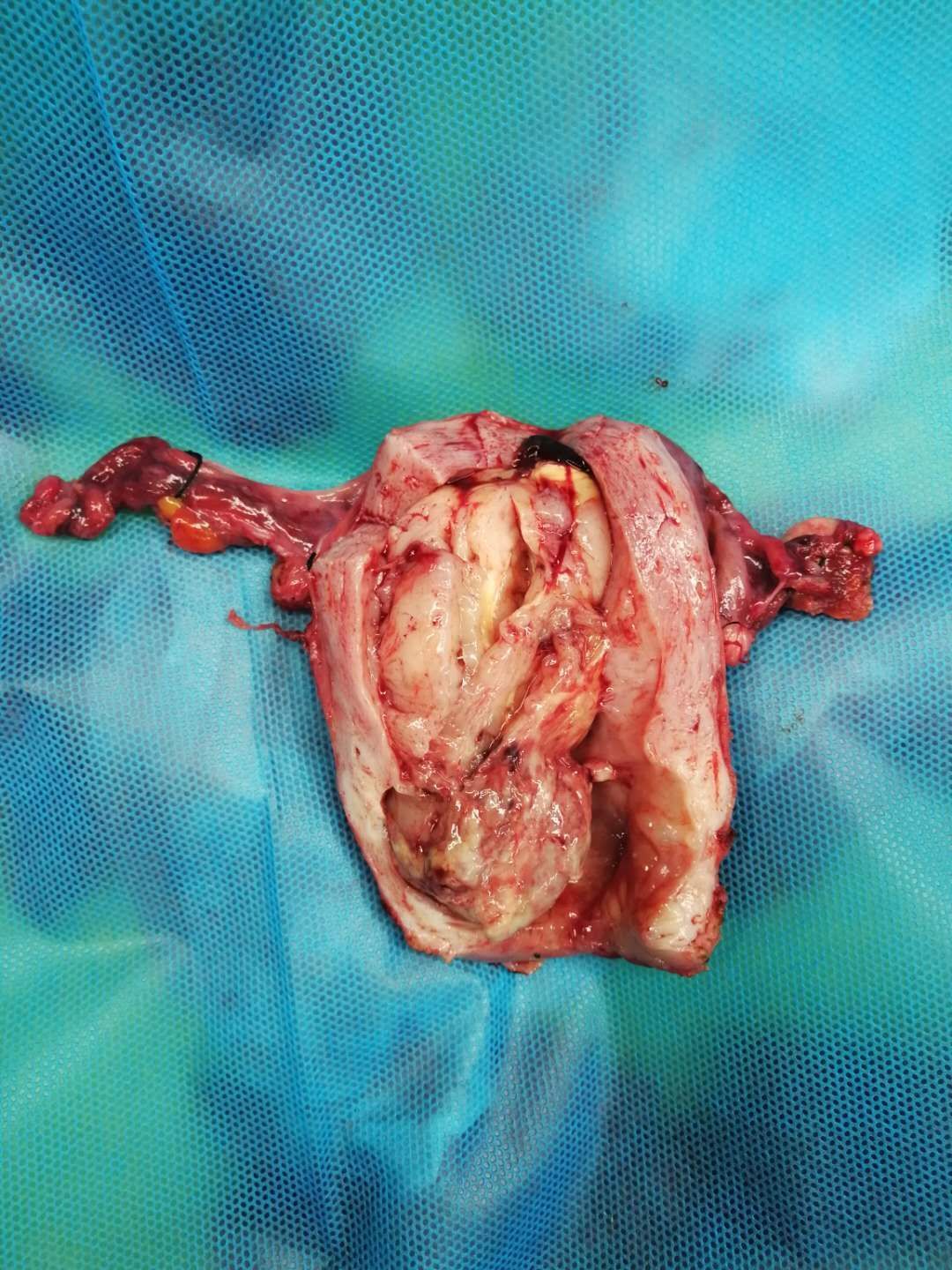 子宫内膜癌排液的图片图片