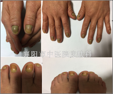 黄甲综合征指甲也是健康的晴雨表