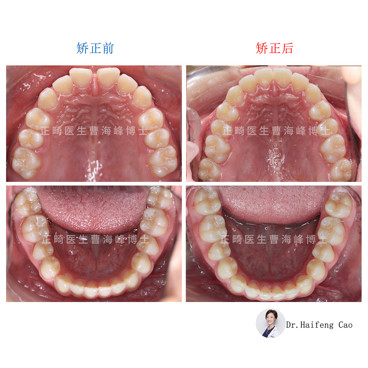 【深覆合,牙列不齊矯正案例】_牙頜畸形 - 好大夫在線