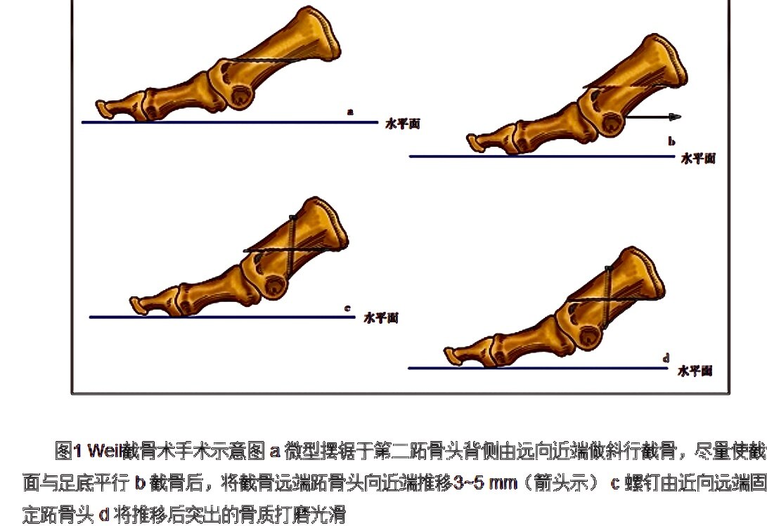 先天性爪趾畸形之二 僵硬型畸形_先天性足畸形_介紹_治療方式_日常