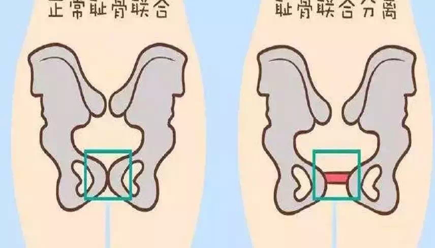 恥骨聯合分離相關科普知識