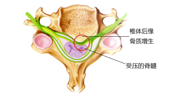 > 手麻那些事儿(之一)颈椎病