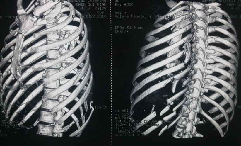开放性肋骨骨折图片图片